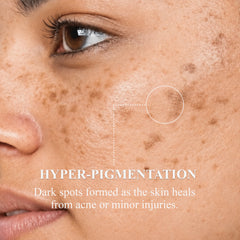 Pigmentation Cream | Salicylic Acid, Mulberry & Papaya Extract Cream | 50g